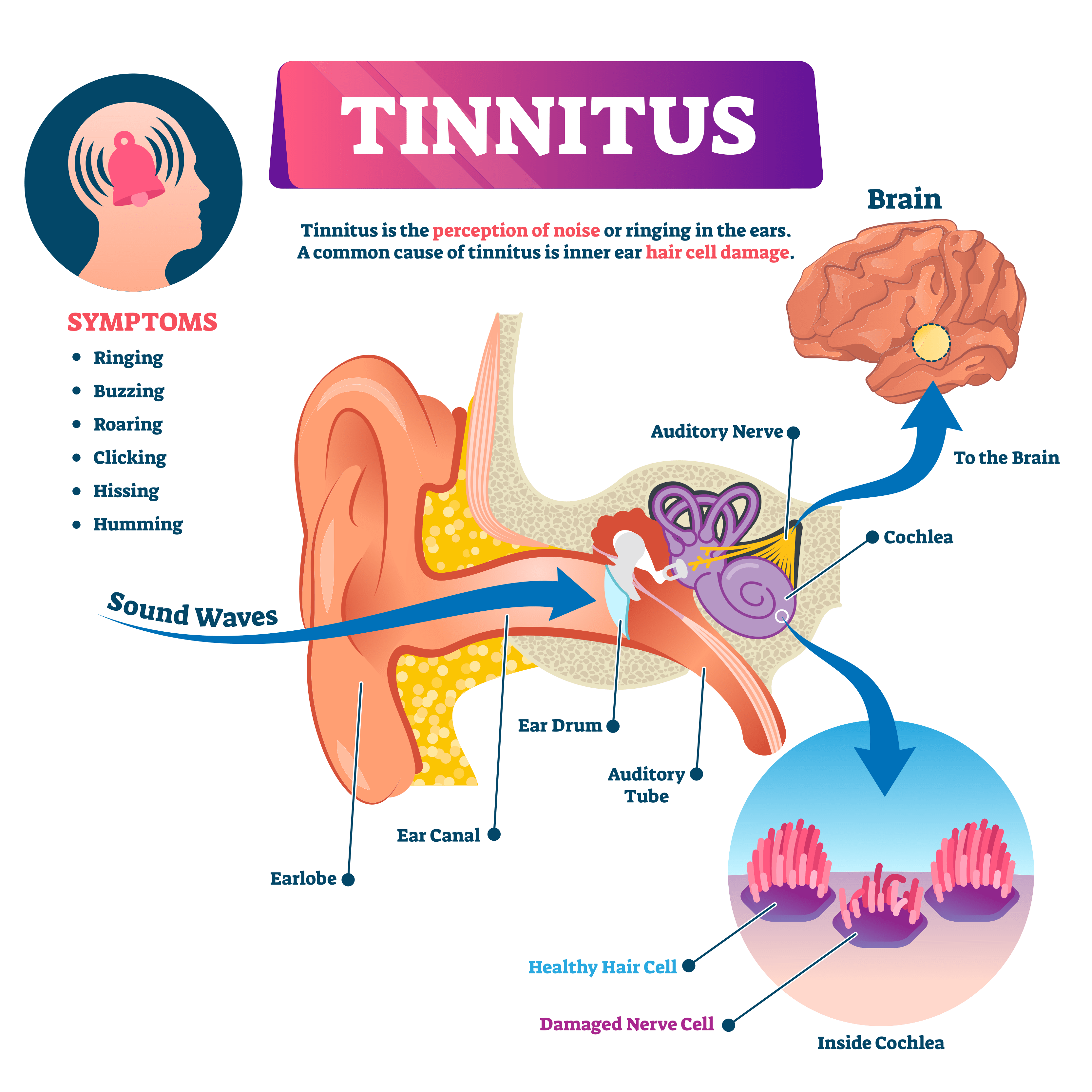 Why Do My Ears Keep Ringing? What You Need to Know About Tinnitus