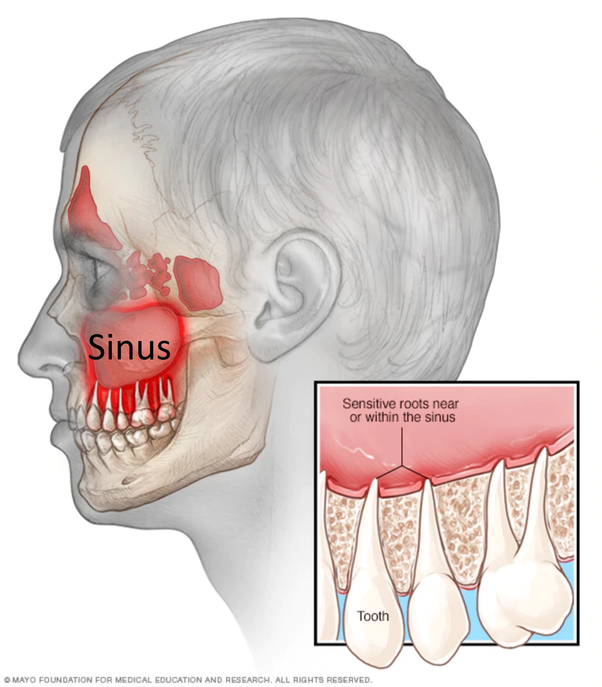 Why does the root of my teeth hurt when I have a sinus ...
